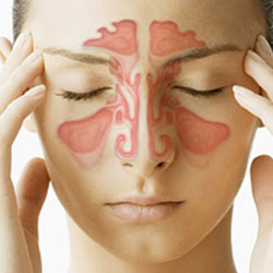 SINUSITIS