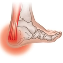 TENDINITIS